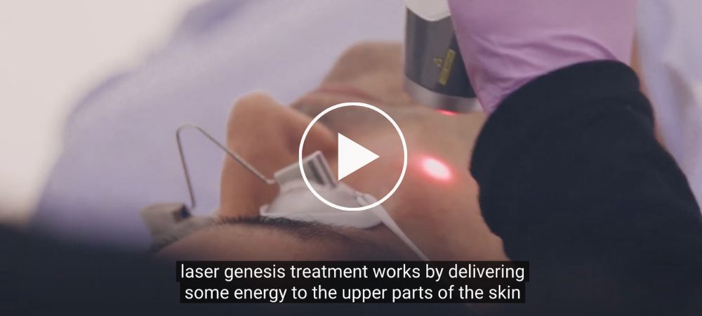 laser genesis acne scarring london