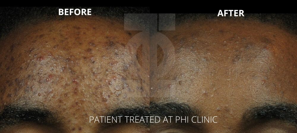 obagi acne result london